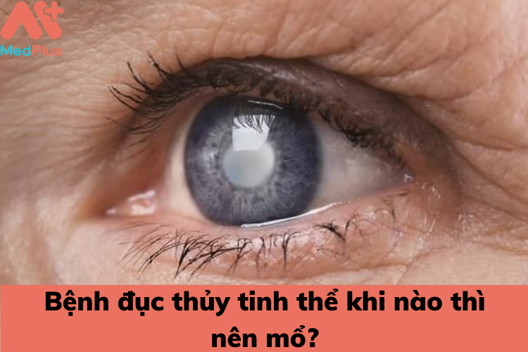 Bệnh đục thủy tinh thể khi nào thì nên mổ?