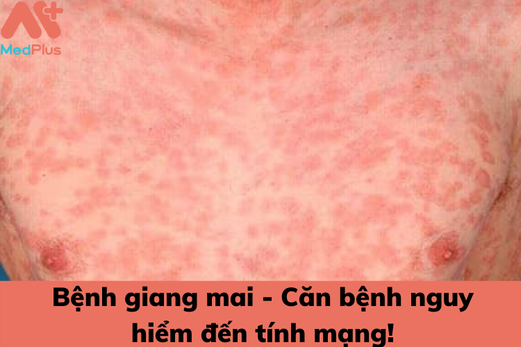 benh giang mai nguy hiem den tinh mang nhu the nao - Medplus