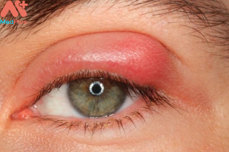 Bệnh lẹo mắt là gì