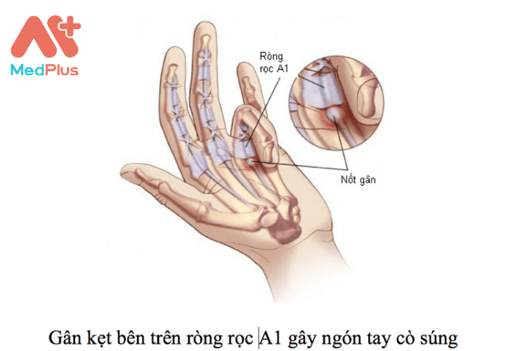 Ngón tay cò súng là tình trạng các ngón tay gặp khó khăn khi duỗi, duỗi không tự nhiên hoặc đau khi cố gắng duỗi. Bệnh nhân thường có dấu hiệu cứng tay khi gấp ngón, khó khăn trong việc sinh hoạt, cầm nắm đồ vật hằng ngày.