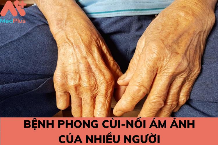 benh phong la noi am anh cua nhieu nguoi - Medplus