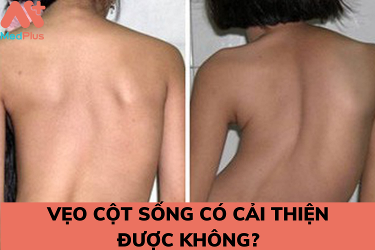 benh veo cot song - Medplus