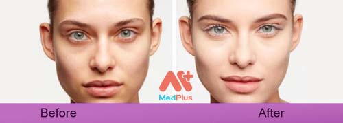 Phân biệt Quầng thâm và Bọng mắt để điều trị dễ dàng hơn! 132 điều trị quầng thâm
