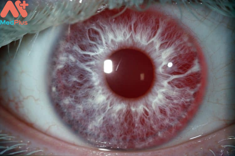 Bệnh bạch tạng ở mắt