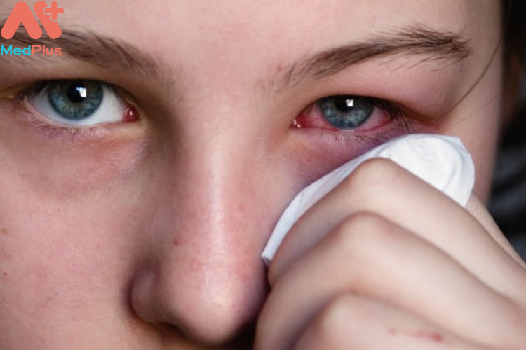 Bệnh đau mắt đỏ còn gọi là bệnh viêm giác mạc