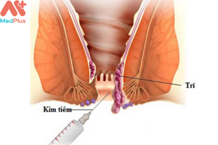 Điều trị bệnh trĩ bằng cách tiêm búi trĩ