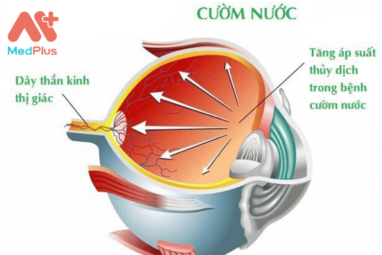 Việc thường xuyên kiểm tra mắt định kỳ sẽ giúp phát hiện và ngăn ngừa bệnh Glaucoma.