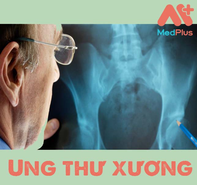 ung thư xương