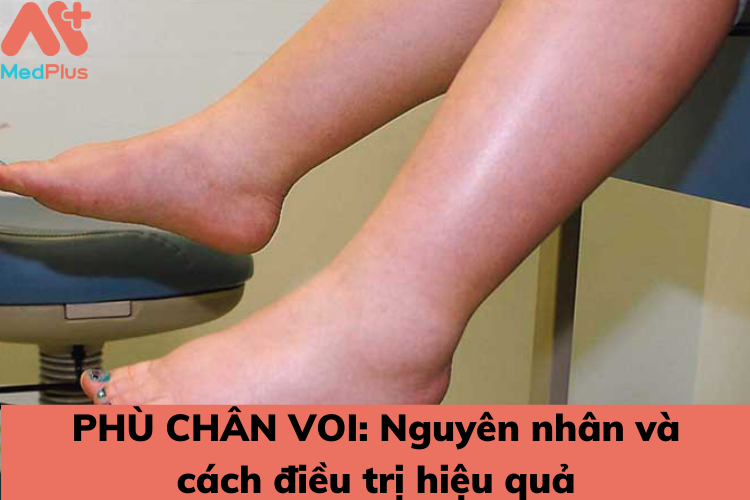 nguyen nhan va dieu tri phu chan voi - Medplus