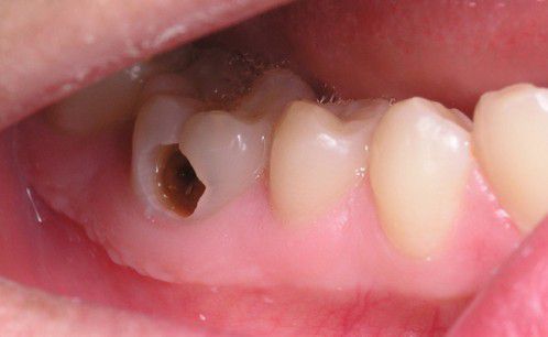 Viêm tủy răng - Là một bệnh lý phổ biến nhưng đa số bệnh nhân thường không dễ phát hiện, do bệnh phát triển rất thầm lặng và nhẹ nhàng