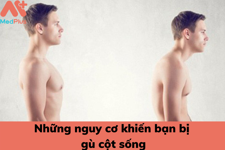 Những nguy cơ khiến bạn bị gù cột sống
