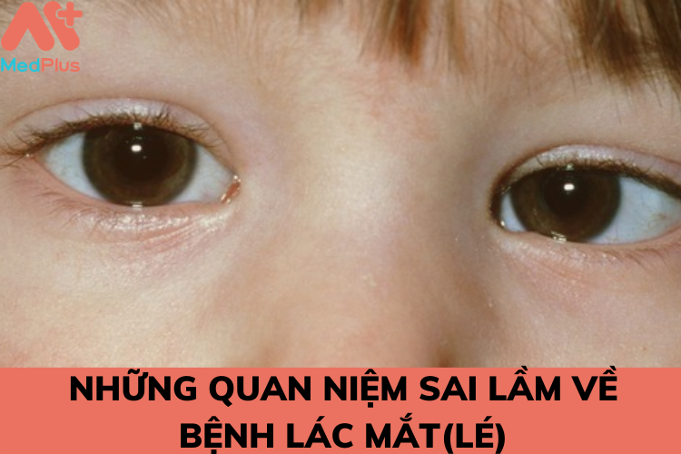 nhung quan niem sai lam ve benh lac mat - Medplus