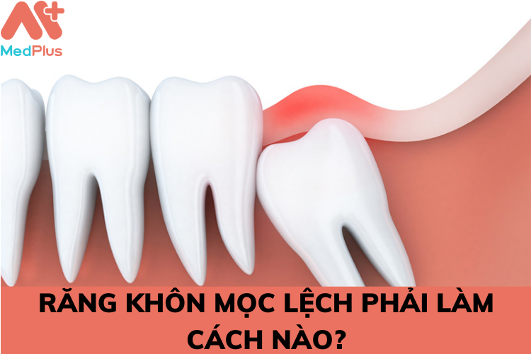 rang khon moc lech - Medplus