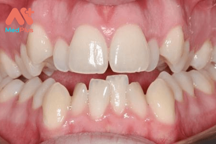 răng thừa