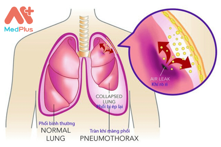 Bệnh có thể lành tính hoặc ác tính, tái lại nhiều lần có thể gây tử vong.