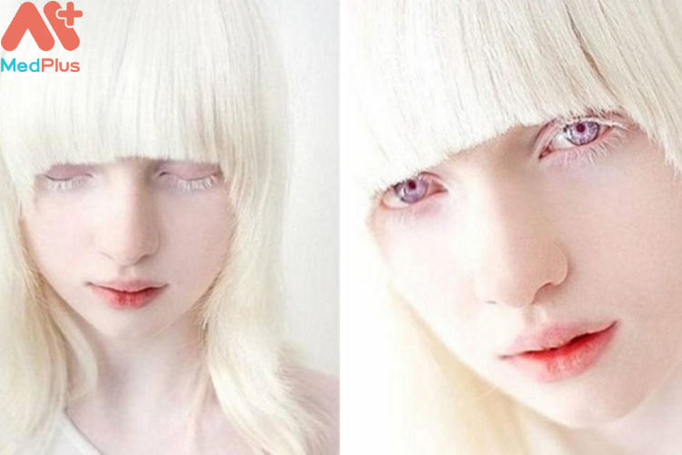 Bạch tạng có điều trị được không?