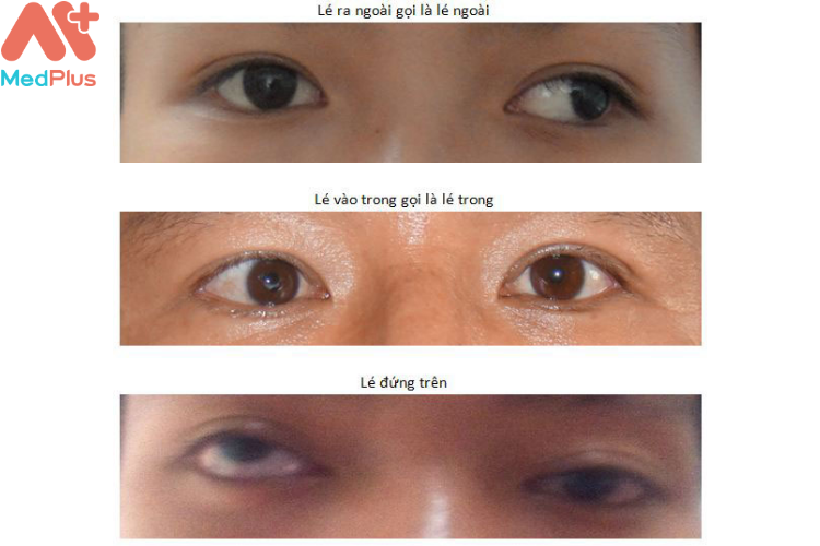 Triệu chứng của bệnh lác mắt
