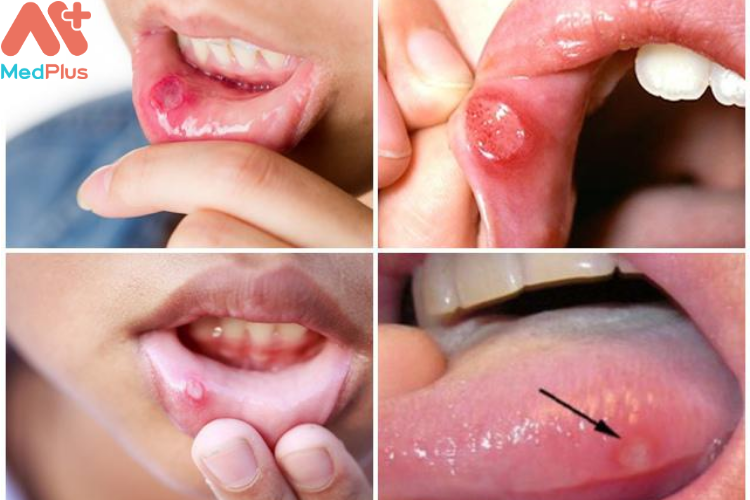 Các triệu chứng thường gặp của nhiệt miệng