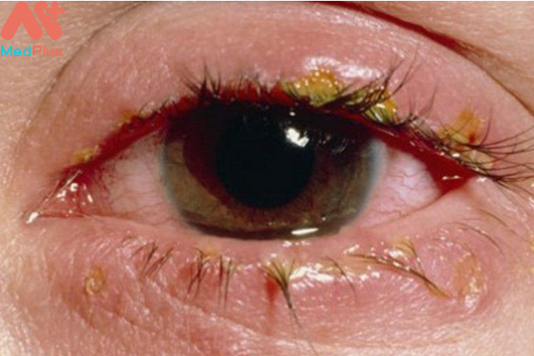 Đỏ mắt, đổ ghèn là triệu chứng phổ biến của bệnh mắt đỏ