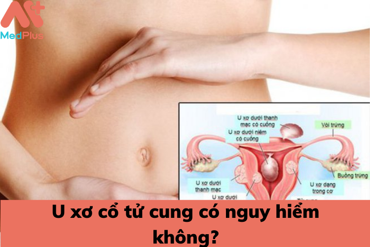 U xơ cổ tử cung có nguy hiểm không? 5 u xo co tu cung co nguy hiem khong - Medplus