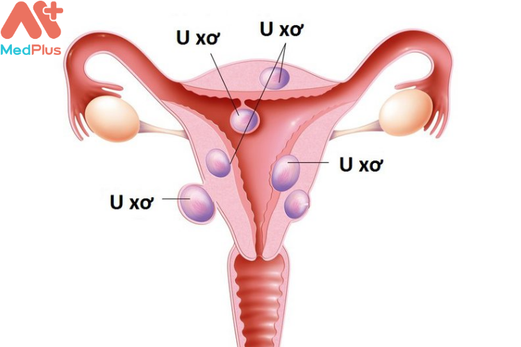 U xơ cổ tử cung có nguy hiểm không? 131 U xơ cổ tử cung là bệnh gì?