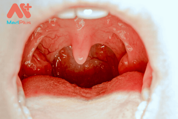 Ung thư vòm họng là gì?