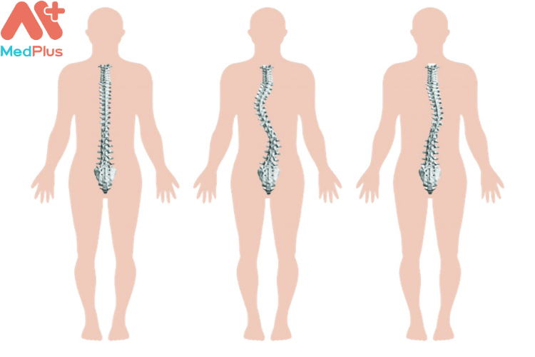 Bênh vẹo cột sống là gì