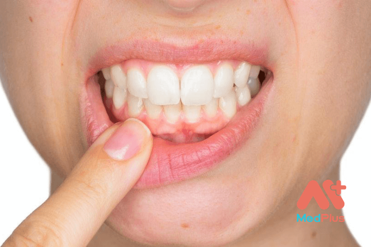 Đồ uống dành cho người bị nhiệt miệng