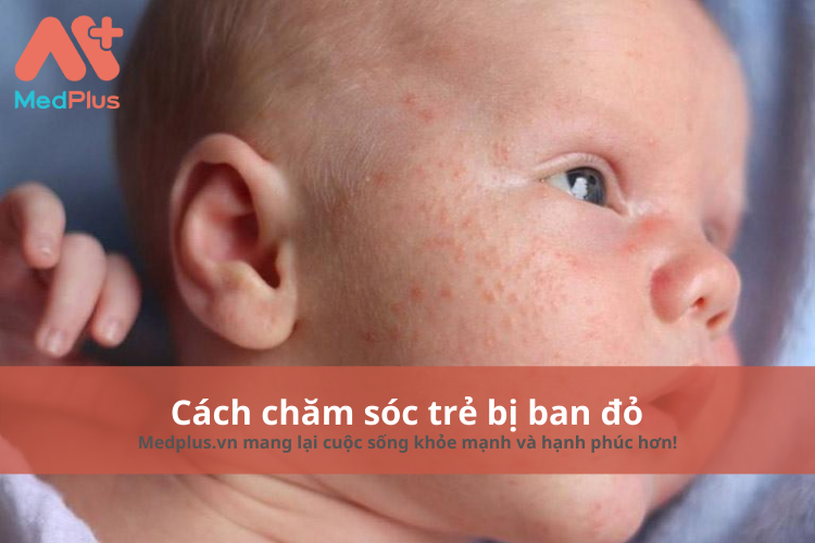 cách chăm sóc trẻ em bị ban đỏ