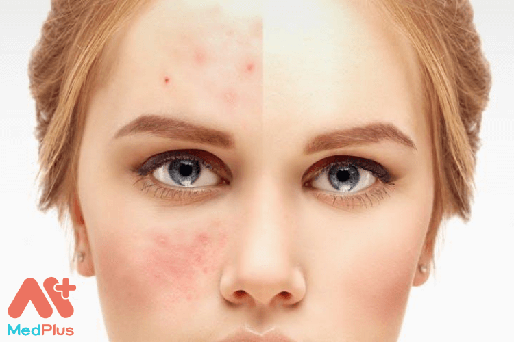 Thức uông cho người bị mụn cải thiện da mặt