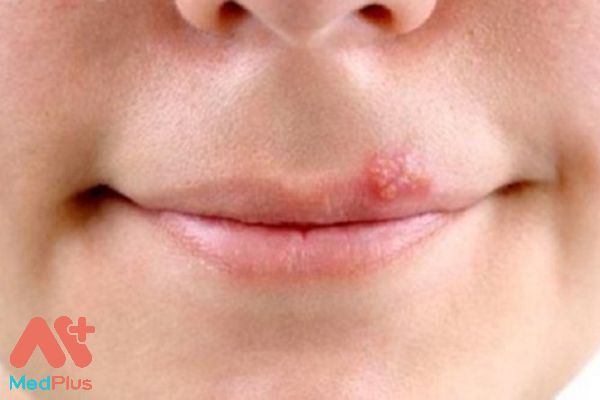 Bỏ túi 6 thông tin hữu ích về bệnh Rộp môi