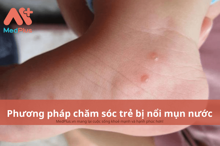 Phương pháp chăm sóc trẻ bị nổi mụn nước an toàn và hiệu quả