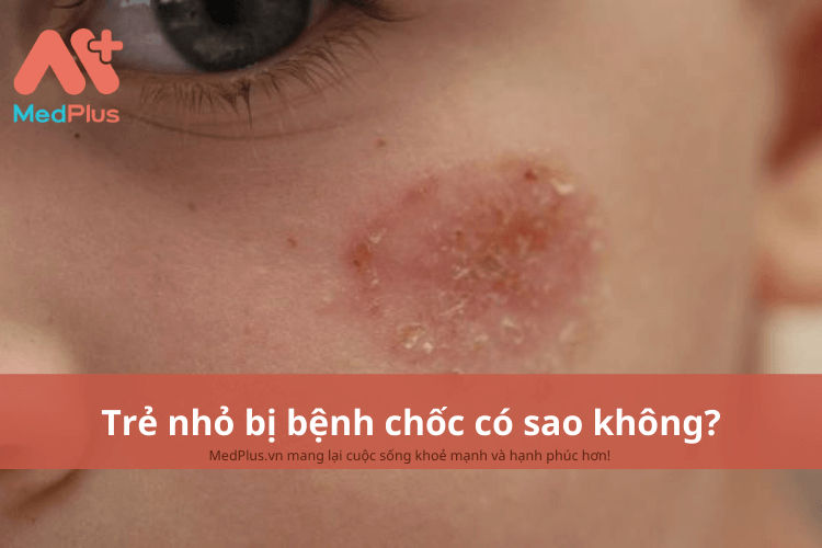 Trẻ nhỏ bị bệnh chốc có sao không?