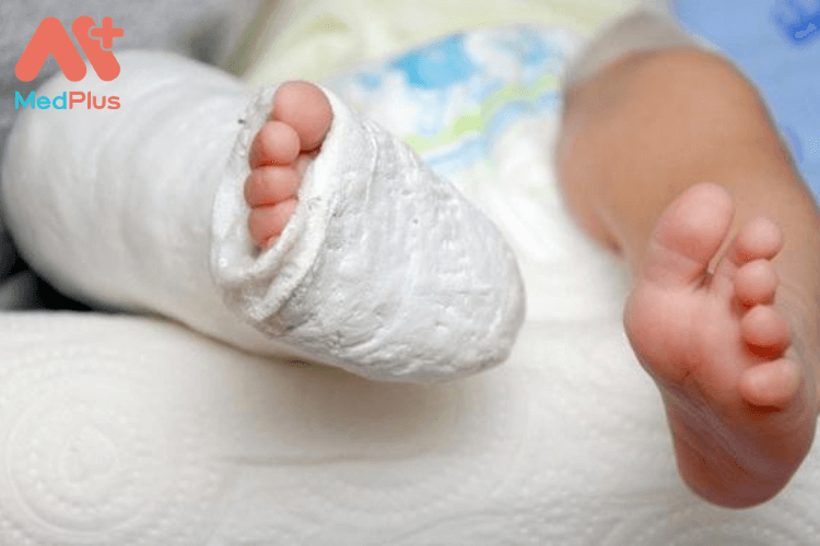 Phương pháp chăm sóc trẻ bị tai biến của bó bột an toàn và hiệu quả