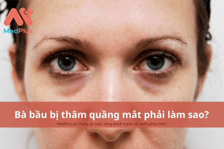 Bà bầu bị thâm quầng mắt phải làm sao?