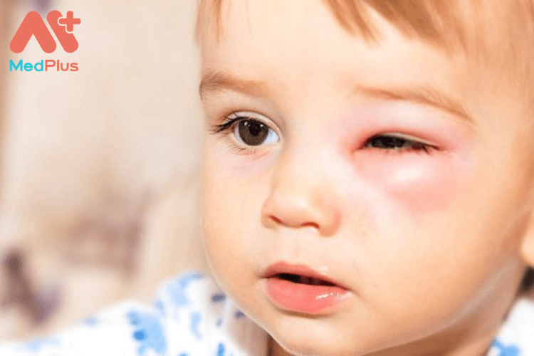 Trẻ nhỏ bị bầm tím mắt có sao không?