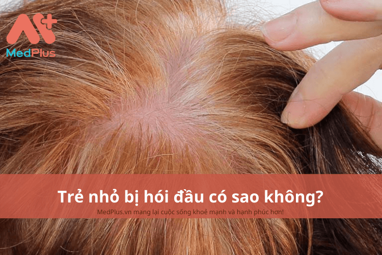 Trẻ nhỏ bị hói đầu có sao không?