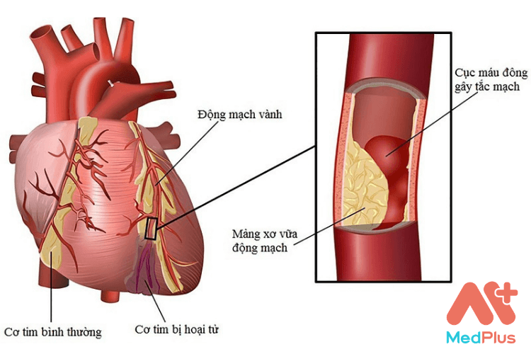 Biến chứng của Cholesterol cao dẫn đến nguy cơ nhồi máu cơ tim