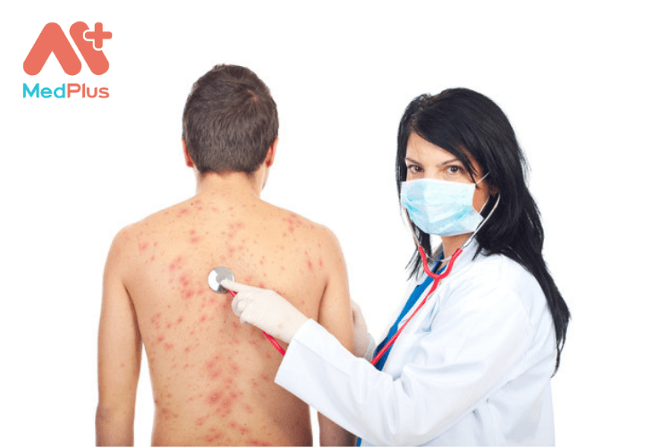 Điều trị lupus ban đỏ bằng tế bào gốc bao nhiêu