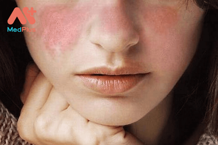 Nguyên nhân và triệu chứng của bệnh lupus ban đỏ là gì?