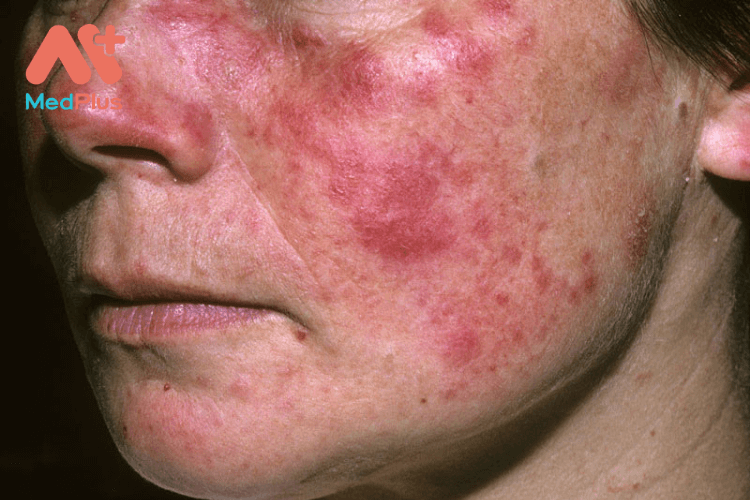 Lupus ban đỏ do nguyên nhân nào? Có những dấu hiệu nào?