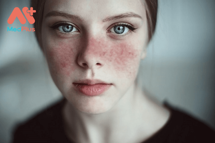 Bệnh lupus ban đỏ là gì? Nguyên nhân và dấu hiệu của bệnh