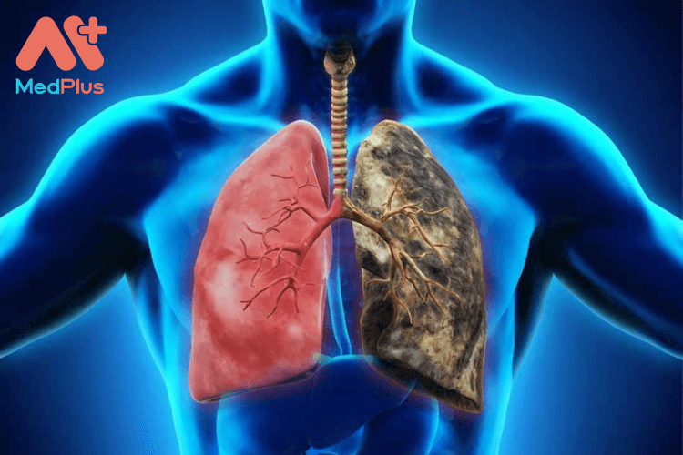 Giới thiệu về bệnh tắc nghẽn phổi mãn tính