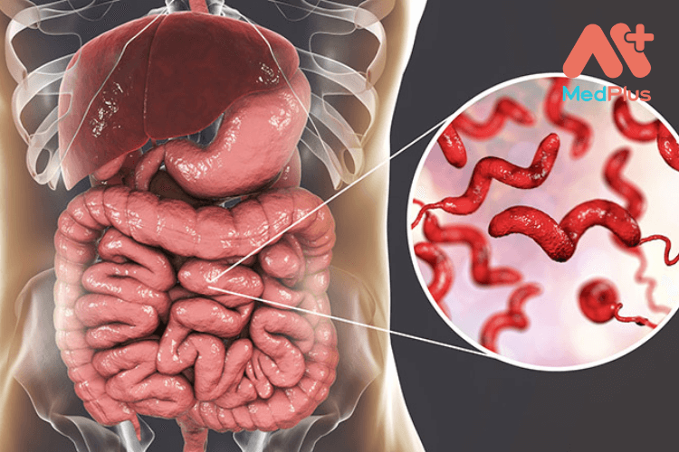 Bệnh viêm dạ dày ruột là gì?
