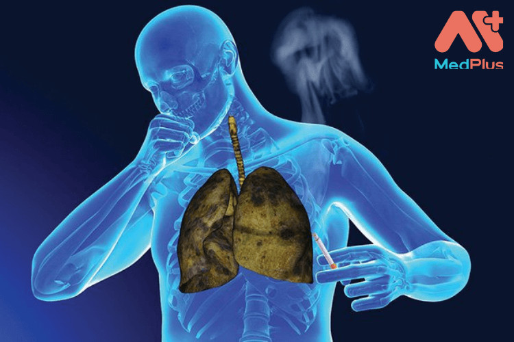 Hút thuốc lá là tác nhân chính gây Ung thư phổi