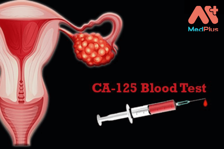 Xét nghiệm CA-125: Phát hiện sớm và tầm soát ung thư buồng trứng. 128 Xét nghiệm CA-125: Phát hiện ung thư buồng trứng