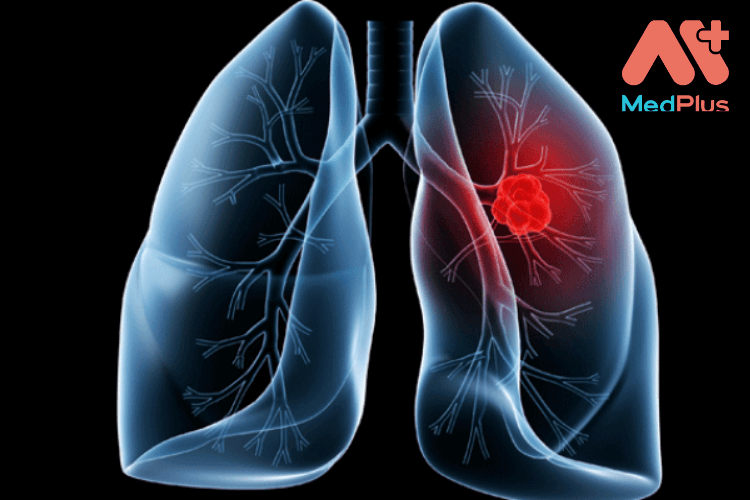 Xét nghiệm Cyfra 21-1 tầm soát ung thư phổi
