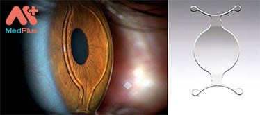 Phẫu thuật mắt tại JIEH