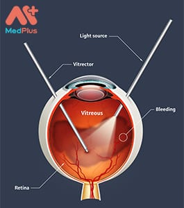 Phẫu thuật mắt tại JIEH