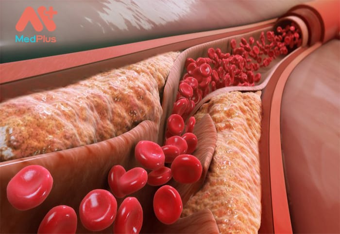 Xét nghiệm Cholesterol toàn phần - Thông tin chi tiết 130 Cholesterol toàn phần
